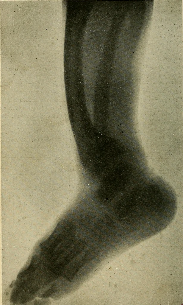 An illustration from The Roentgen rays in medicine and surgery as an aid in diagnosis and as a therapeutic agent : designed for the use of practitioners and students, 1901, leaf 593