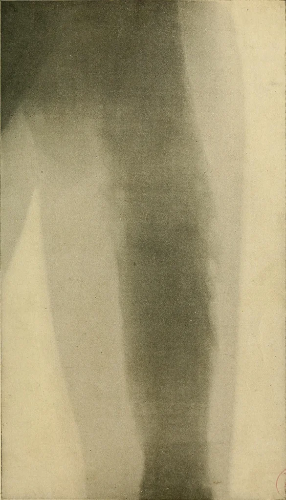 An illustration from The Roentgen rays in medicine and surgery as an aid in diagnosis and as a therapeutic agent : designed for the use of practitioners and students, 1901, leaf 596