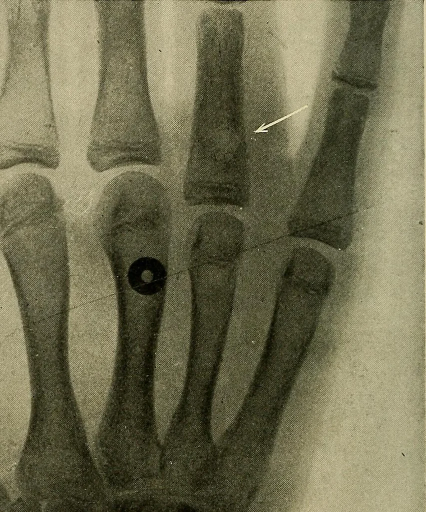 An illustration from The Roentgen rays in medicine and surgery as an aid in diagnosis and as a therapeutic agent : designed for the use of practitioners and students, 1901, leaf 599