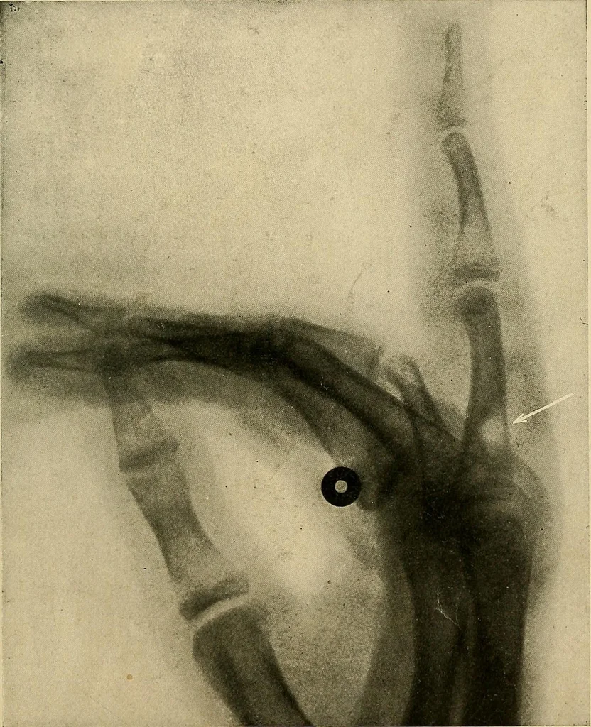 An illustration from The Roentgen rays in medicine and surgery as an aid in diagnosis and as a therapeutic agent : designed for the use of practitioners and students, 1901, leaf 600