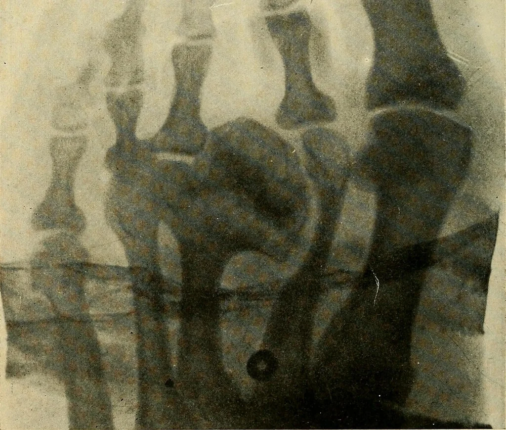 An illustration from The Roentgen rays in medicine and surgery as an aid in diagnosis and as a therapeutic agent : designed for the use of practitioners and students, 1901, leaf 603