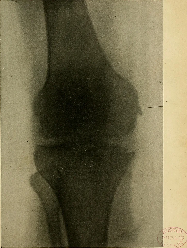An illustration from The Roentgen rays in medicine and surgery as an aid in diagnosis and as a therapeutic agent : designed for the use of practitioners and students, 1901, leaf 612