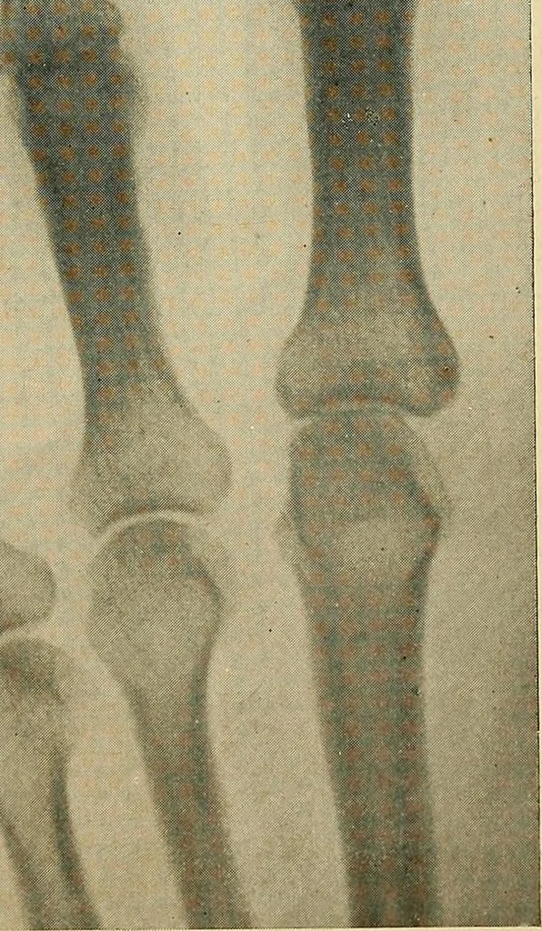 An illustration from The Roentgen rays in medicine and surgery as an aid in diagnosis and as a therapeutic agent : designed for the use of practitioners and students, 1901, leaf 614