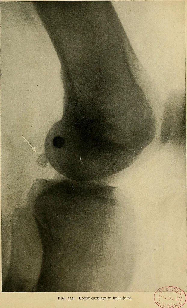An illustration from The Roentgen rays in medicine and surgery as an aid in diagnosis and as a therapeutic agent : designed for the use of practitioners and students, 1901, leaf 616