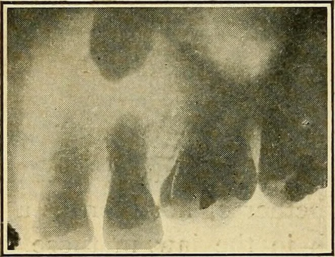 An illustration from The Roentgen rays in medicine and surgery as an aid in diagnosis and as a therapeutic agent : designed for the use of practitioners and students, 1901, leaf 625