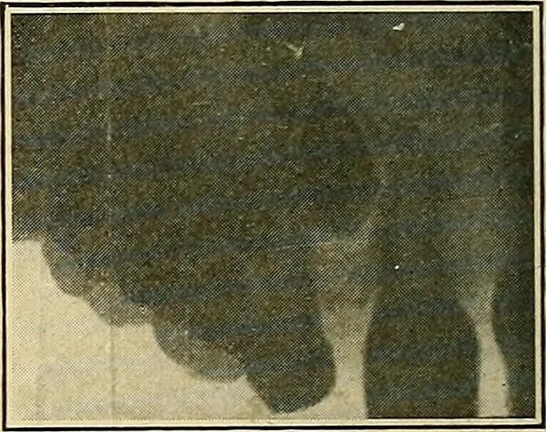An illustration from The Roentgen rays in medicine and surgery as an aid in diagnosis and as a therapeutic agent : designed for the use of practitioners and students, 1901, leaf 625