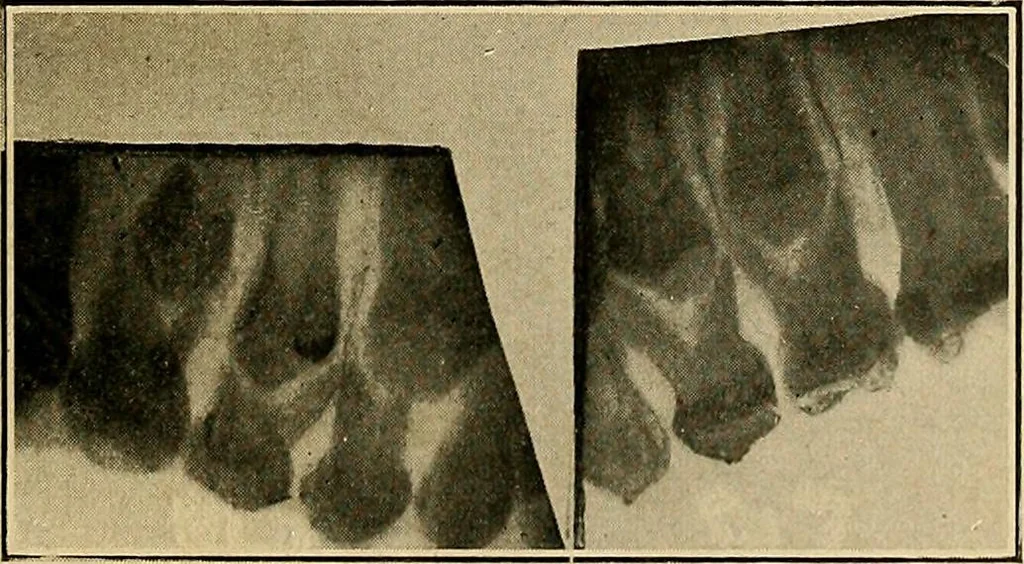 An illustration from The Roentgen rays in medicine and surgery as an aid in diagnosis and as a therapeutic agent : designed for the use of practitioners and students, 1901, leaf 626