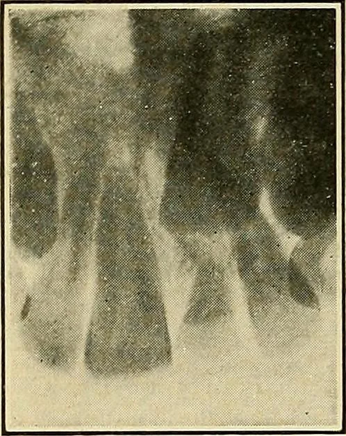An illustration from The Roentgen rays in medicine and surgery as an aid in diagnosis and as a therapeutic agent : designed for the use of practitioners and students, 1901, leaf 627