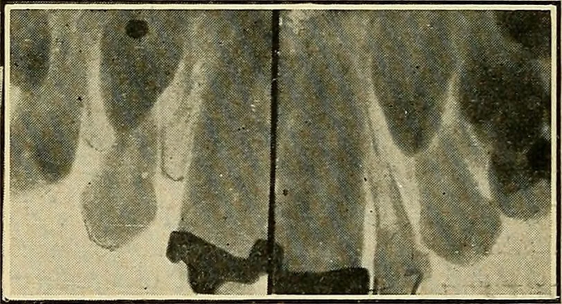 An illustration from The Roentgen rays in medicine and surgery as an aid in diagnosis and as a therapeutic agent : designed for the use of practitioners and students, 1901, leaf 627