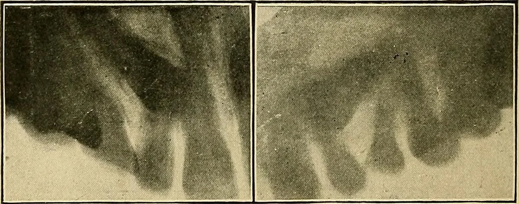 An illustration from The Roentgen rays in medicine and surgery as an aid in diagnosis and as a therapeutic agent : designed for the use of practitioners and students, 1901, leaf 627