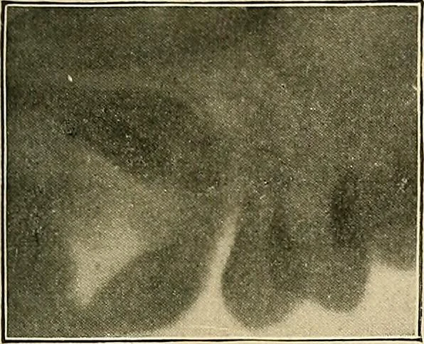 An illustration from The Roentgen rays in medicine and surgery as an aid in diagnosis and as a therapeutic agent : designed for the use of practitioners and students, 1901, leaf 628