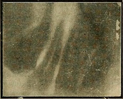 An illustration from The Roentgen rays in medicine and surgery as an aid in diagnosis and as a therapeutic agent : designed for the use of practitioners and students, 1901, leaf 628