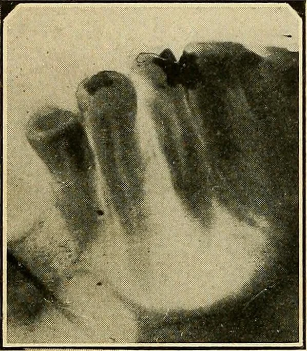 An illustration from The Roentgen rays in medicine and surgery as an aid in diagnosis and as a therapeutic agent : designed for the use of practitioners and students, 1901, leaf 629