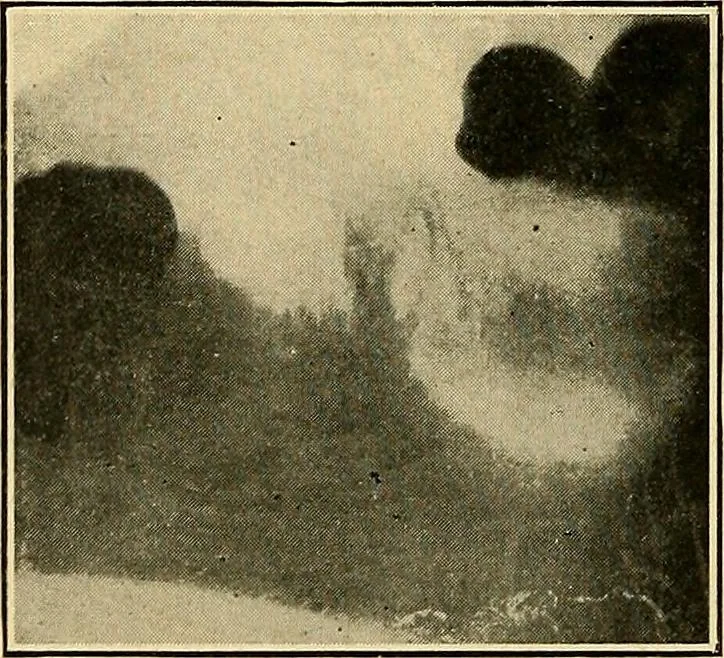 An illustration from The Roentgen rays in medicine and surgery as an aid in diagnosis and as a therapeutic agent : designed for the use of practitioners and students, 1901, leaf 629