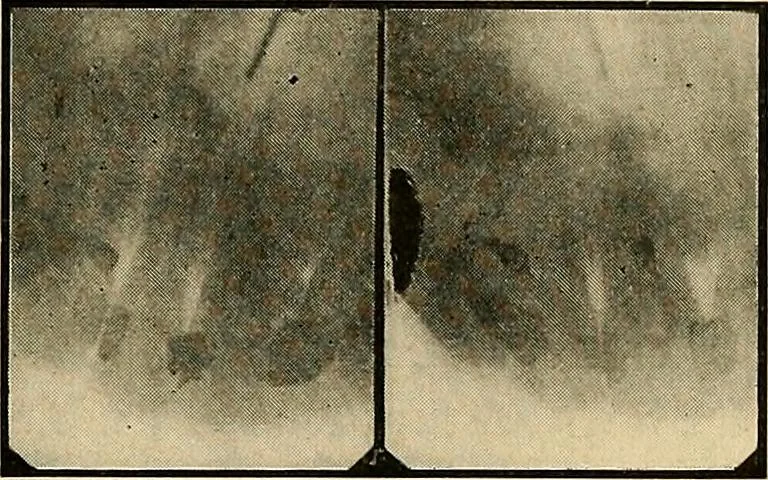 An illustration from The Roentgen rays in medicine and surgery as an aid in diagnosis and as a therapeutic agent : designed for the use of practitioners and students, 1901, leaf 630