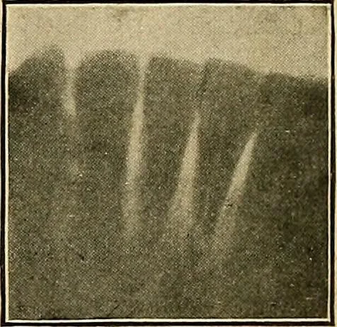 An illustration from The Roentgen rays in medicine and surgery as an aid in diagnosis and as a therapeutic agent : designed for the use of practitioners and students, 1901, leaf 630