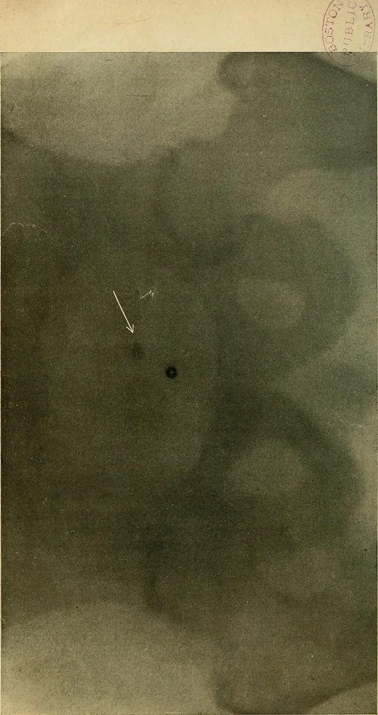 An illustration from The Roentgen rays in medicine and surgery as an aid in diagnosis and as a therapeutic agent : designed for the use of practitioners and students, 1901, leaf 635