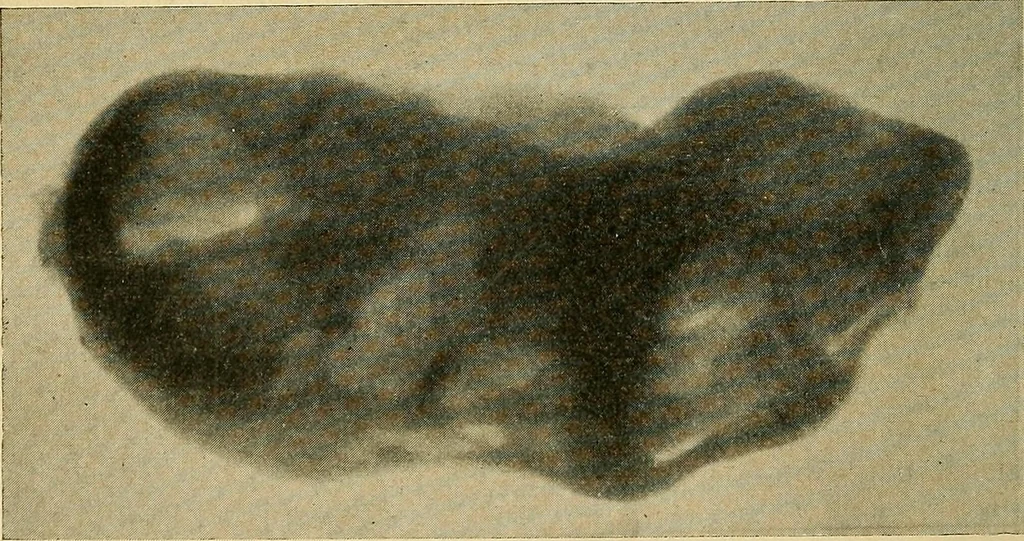 An illustration from The Roentgen rays in medicine and surgery as an aid in diagnosis and as a therapeutic agent : designed for the use of practitioners and students, 1901, leaf 637