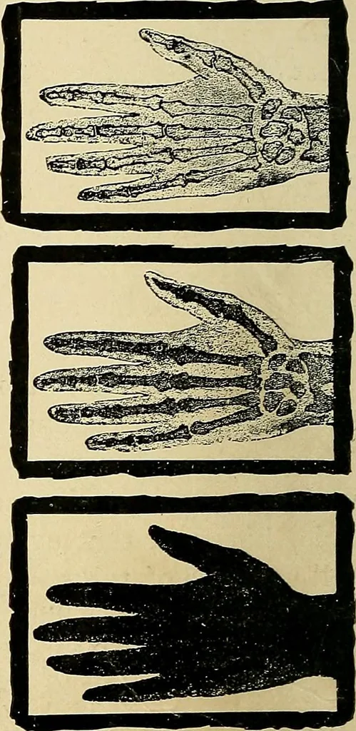 An illustration from The Roentgen rays in medicine and surgery as an aid in diagnosis and as a therapeutic agent : designed for the use of practitioners and students, 1901, leaf 79