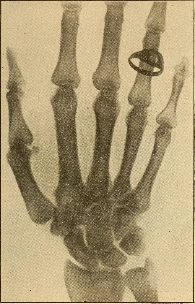 An illustration from Something about X rays for everybody, 1896, leaf 52