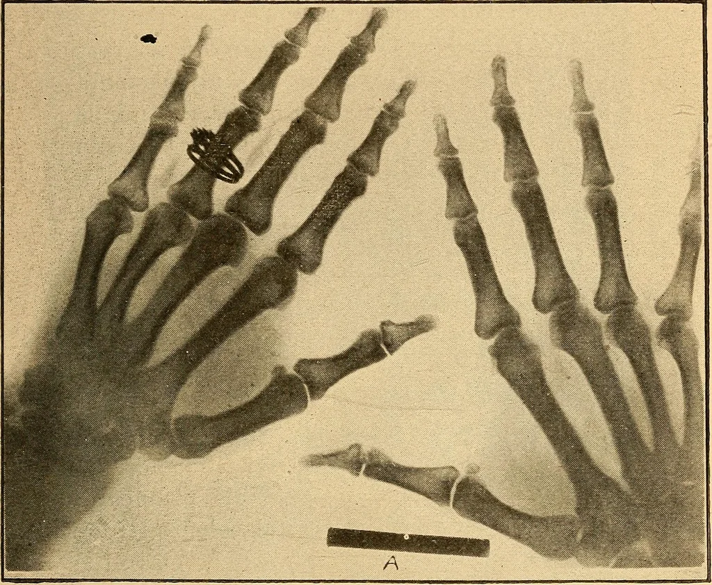 An illustration from Something about X rays for everybody, 1896, leaf 56