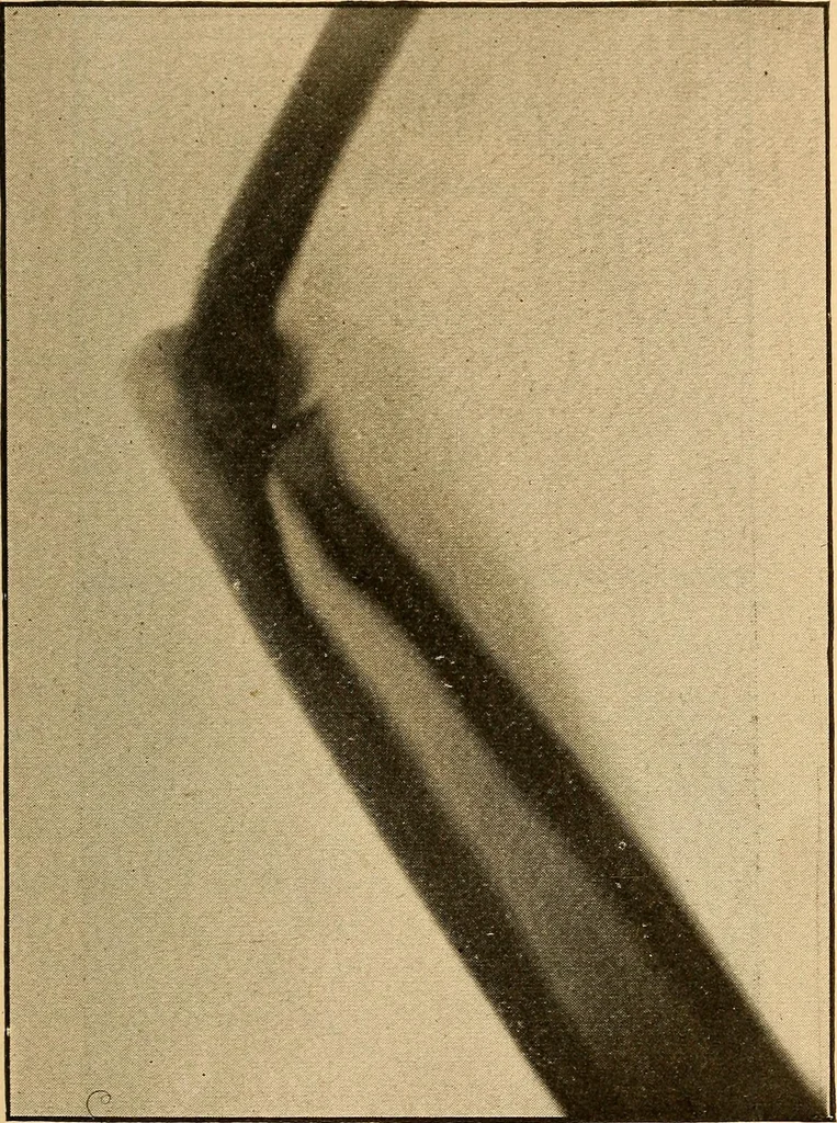 An illustration from Something about X rays for everybody, 1896, leaf 68