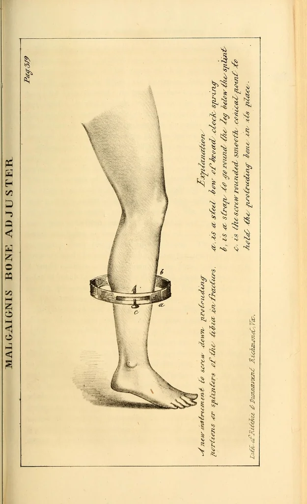 An illustration from The Stethoscope : a monthly journal of medicine and the collateral sciences, 1854, leaf 337