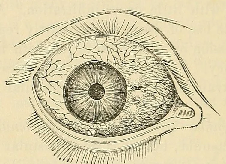 An illustration from The student's guide to diseases of the eye, 1887, leaf 140