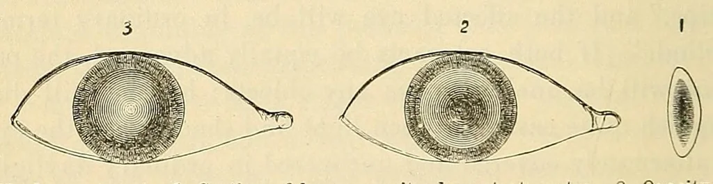 An illustration from The student's guide to diseases of the eye, 1887, leaf 204
