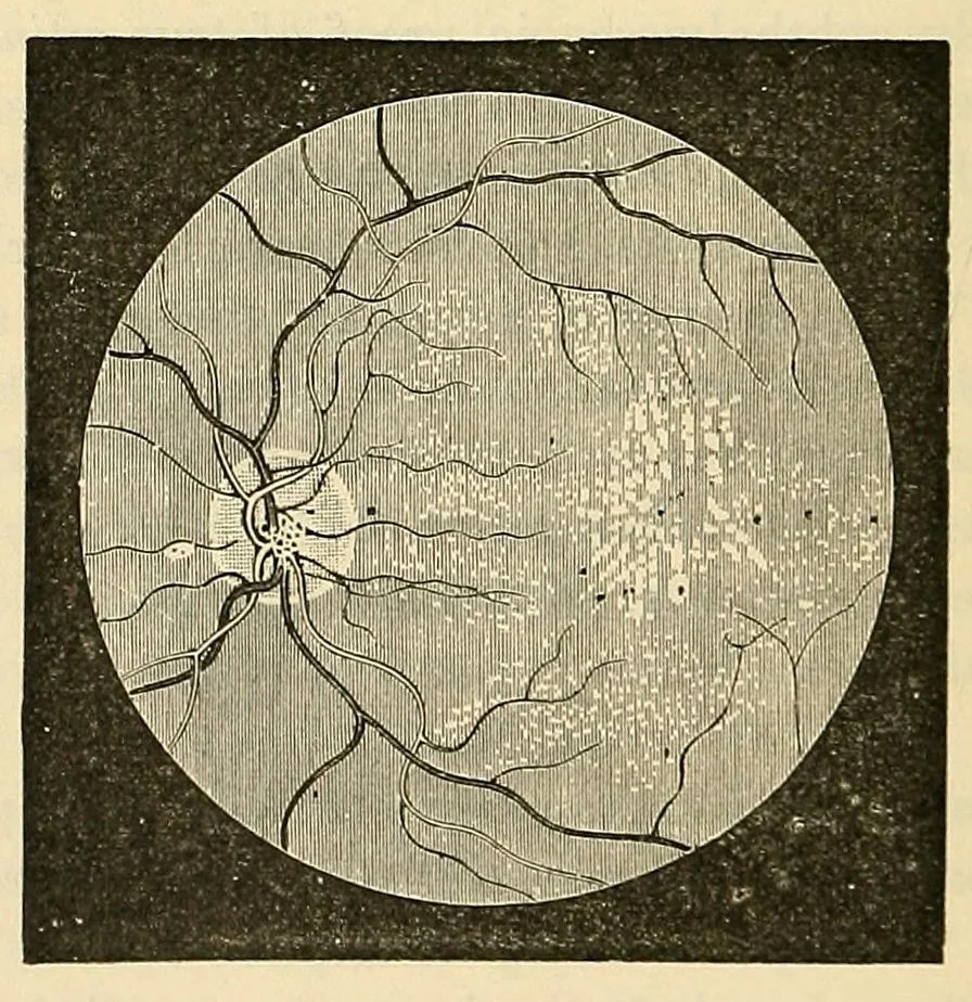 An illustration from The student's guide to diseases of the eye, 1887, leaf 238