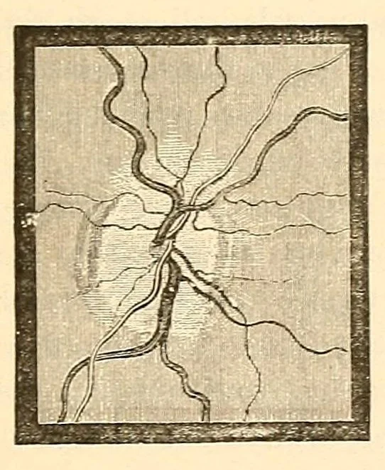 An illustration from The student's guide to diseases of the eye, 1887, leaf 261