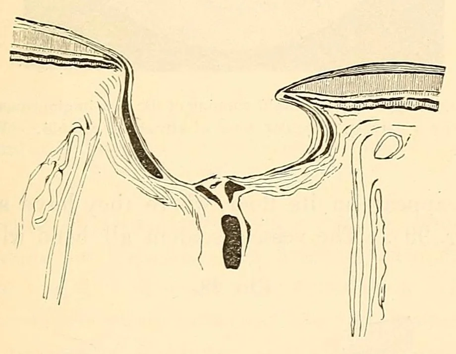 An illustration from The student's guide to diseases of the eye, 1887, leaf 297