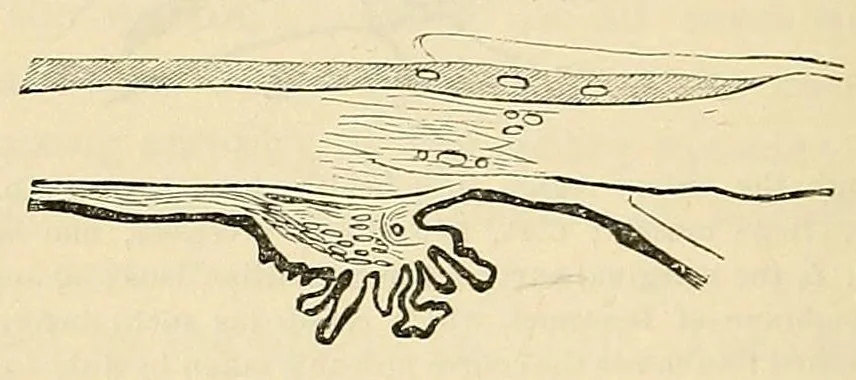 An illustration from The student's guide to diseases of the eye, 1887, leaf 302