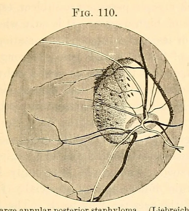 An illustration from The student's guide to diseases of the eye, 1887, leaf 337