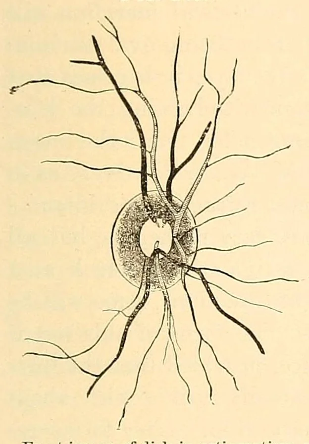 An illustration from The student's guide to diseases of the eye, 1887, leaf 357