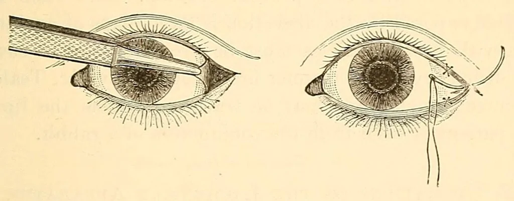 An illustration from The student's guide to diseases of the eye, 1887, leaf 393