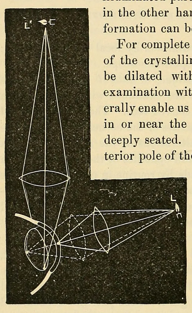 An illustration from The student's guide to diseases of the eye, 1887, leaf 78
