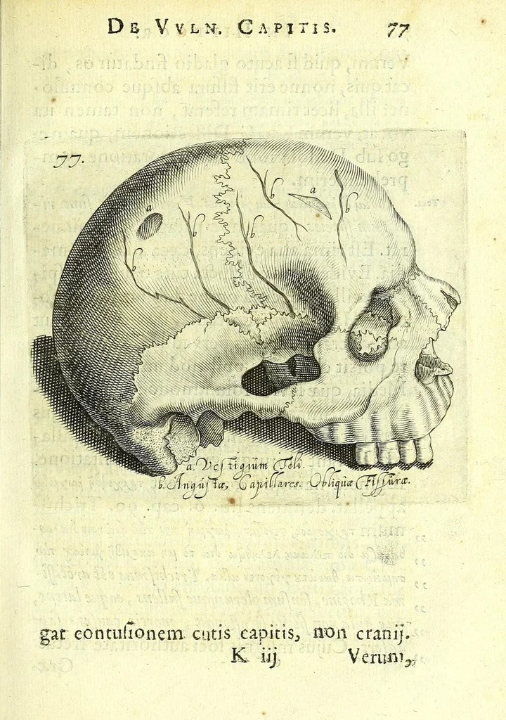 An illustration from Succenturiatus anatomicus : continens commentaria in Hippocratem : De capitis vulneribus :, 1616, leaf 113