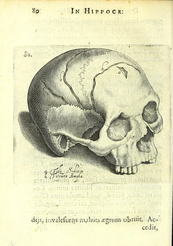 An illustration from Succenturiatus anatomicus : continens commentaria in Hippocratem : De capitis vulneribus :, 1616, leaf 116