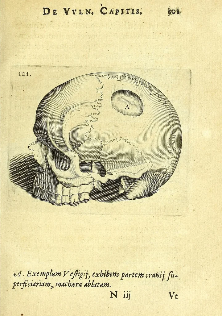 An illustration from Succenturiatus anatomicus : continens commentaria in Hippocratem : De capitis vulneribus :, 1616, leaf 137