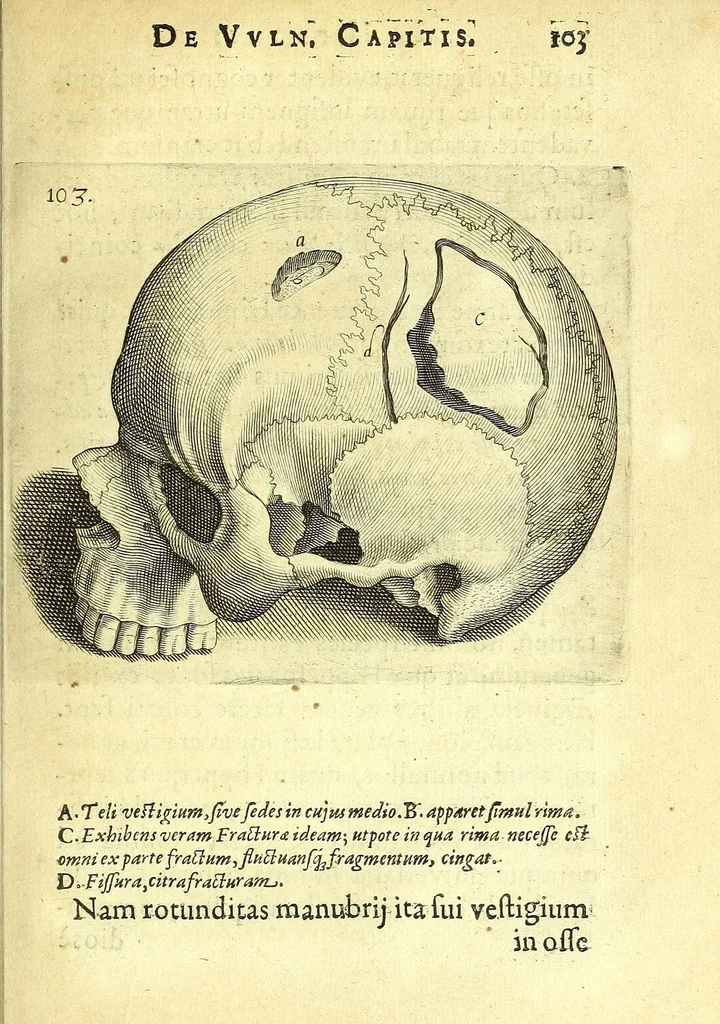 An illustration from Succenturiatus anatomicus : continens commentaria in Hippocratem : De capitis vulneribus :, 1616, leaf 139