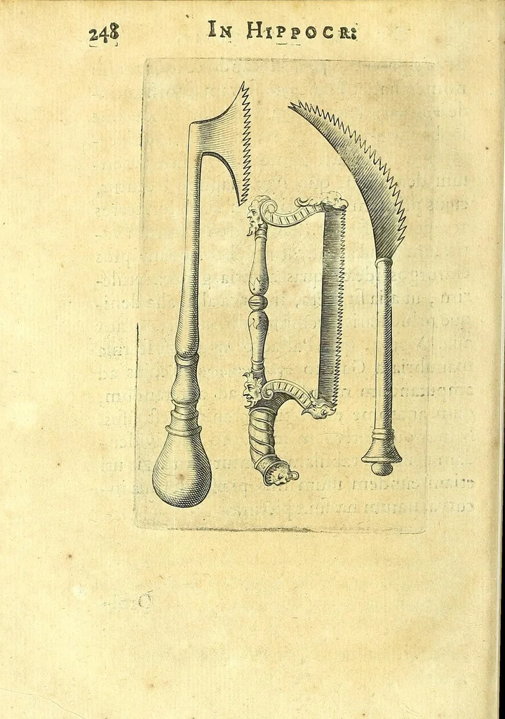 An illustration from Succenturiatus anatomicus : continens commentaria in Hippocratem : De capitis vulneribus :, 1616, leaf 282