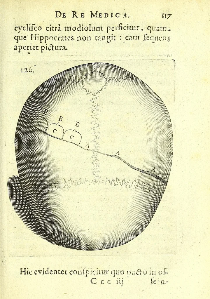An illustration from Succenturiatus anatomicus : continens commentaria in Hippocratem : De capitis vulneribus :, 1616, leaf 423
