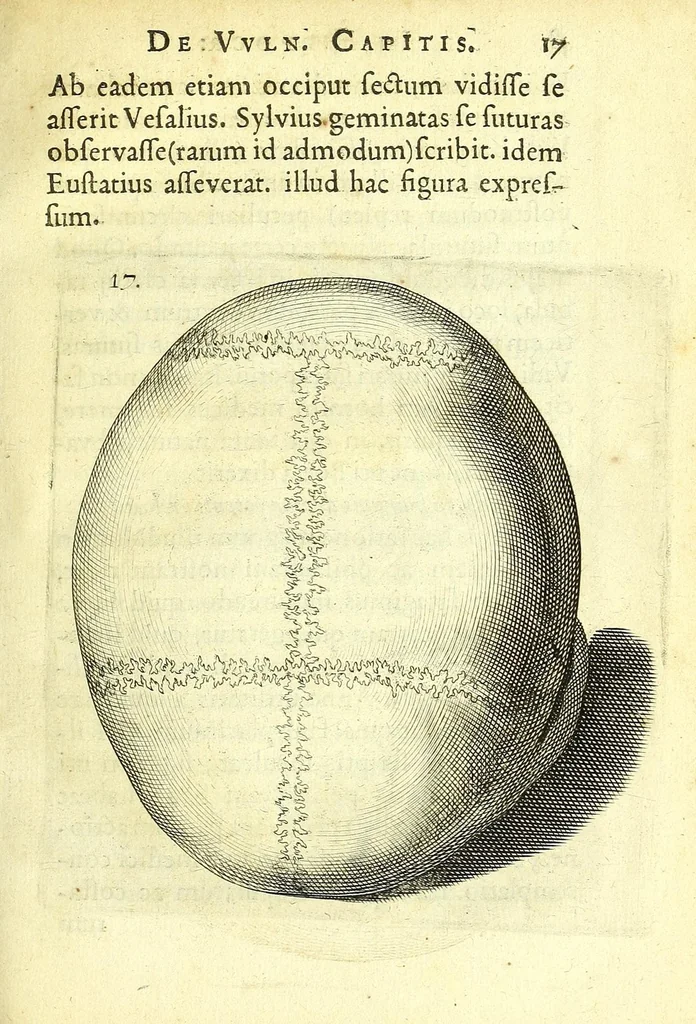 An illustration from Succenturiatus anatomicus : continens commentaria in Hippocratem : De capitis vulneribus :, 1616, leaf 51