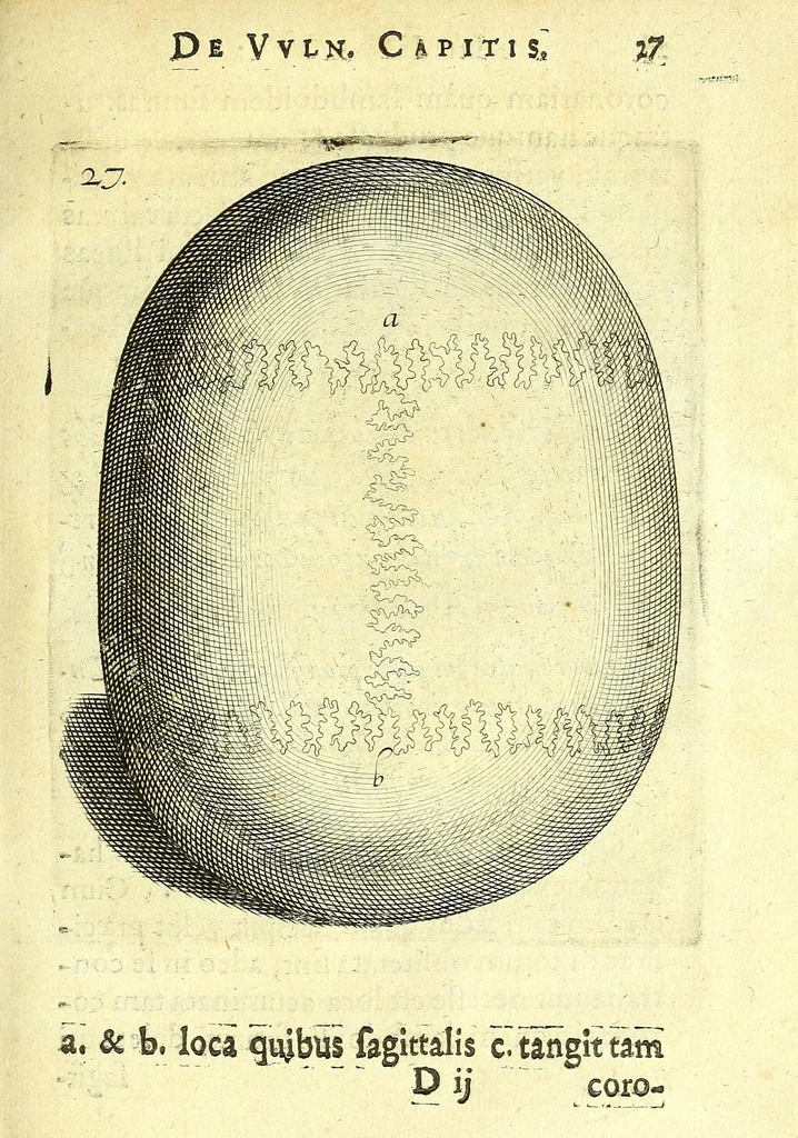 An illustration from Succenturiatus anatomicus : continens commentaria in Hippocratem : De capitis vulneribus :, 1616, leaf 61