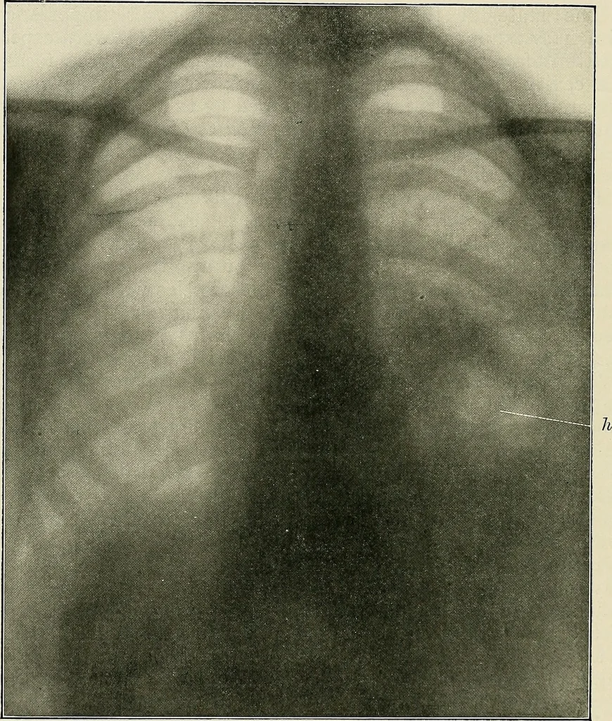 An illustration from Surgery of the lung, 1913, leaf 111