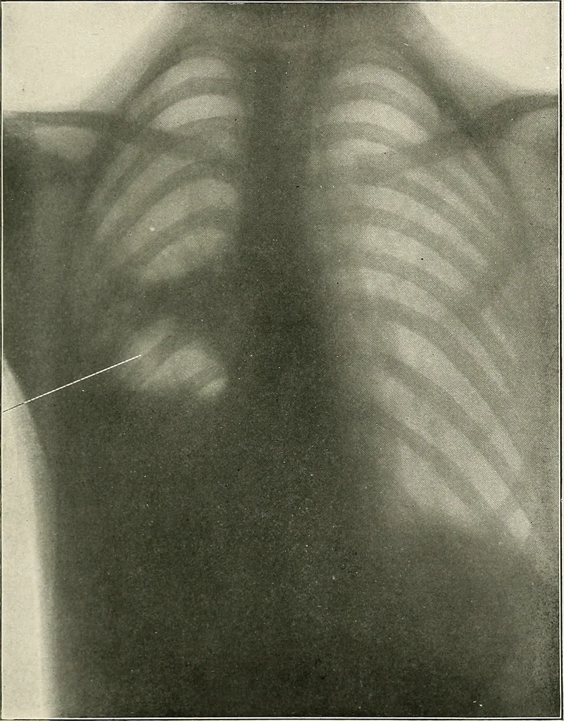 An illustration from Surgery of the lung, 1913, leaf 112