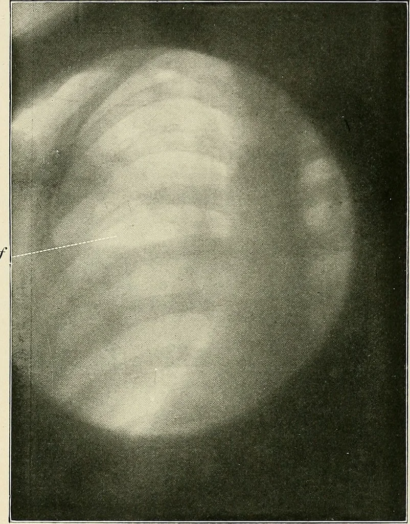 An illustration from Surgery of the lung, 1913, leaf 113