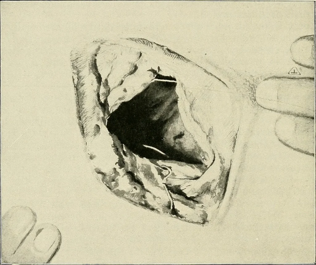 An illustration from Surgery of the lung, 1913, leaf 137