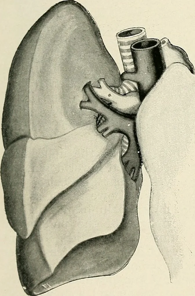 An illustration from Surgery of the lung, 1913, leaf 144